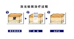 激光祛斑有后遗症吗?随着医美技术的不断扩展，有一些爱美群体会选择激光方式，让自身脸上出现的斑点都有良好改良，这种方式虽然在如今相对而言比较可靠。如果在后期的护理上没...