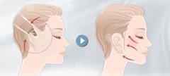 小拉皮和微拉美哪个效果好?如今随着医美领域的不断拓展，面部抗衰的手术方式也比较多变，其中小拉皮和微拉美也是临床运用较为广泛的两种手术方式，大多数人对于这两种方式的操...