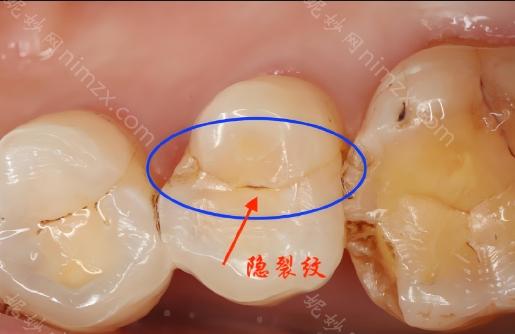 牙隐裂是无法自行愈合的。一旦发现裂痕，应尽快咨询专业牙医进行检查。裂纹中可能藏有细菌，需要进行根管治疗以确保牙齿健康。之后，建议为牙齿安装牙套以提供额外保护，避免因咀嚼导致