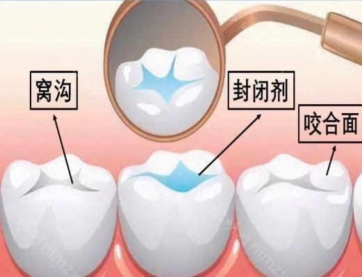 窝沟封闭是一种得到世界卫生组织推荐的预防龋齿的有效方法。其原理是使用对人体无害的高分子树脂材料填充窝沟，树脂硬化后可长期保护牙齿，防止细菌侵蚀，从而预防蛀牙。