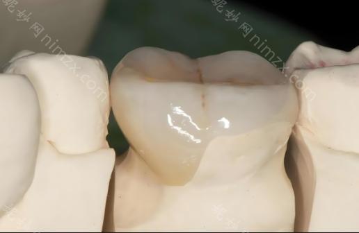 嵌体与牙冠的区别：嵌体适用于牙洞较大，无法通过常规补牙方法修复的情况，同时能够较好地保留健康的牙体组织。牙冠/牙套适合于补牙后无法恢复咀嚼功能的情况。