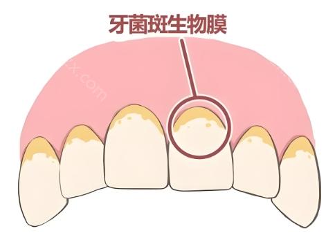 想要清除黑色牙菌斑，可以使用漱口水，可以减少牙菌斑形成，帮助分解食物残渣和牙菌蛋白，但应注意适量使用。使用牙线：有效清除牙齿邻面的牙菌斑，但对于牙龈萎缩严重或牙根面凹陷的人
