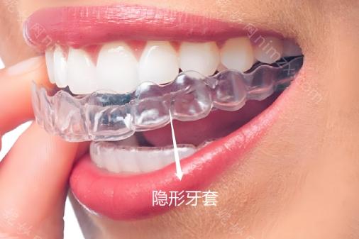 隐适美牙套的价格并不固定，比如标准版隐适美牙套的价格可能在20000元左右起，加强版相比标准版可能价格稍高。