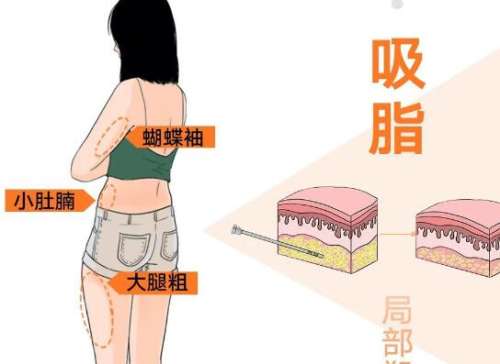 在四季如春的昆明，医美行业的发展同样如火如荼，吸脂手术凭借立竿见影的塑形效果，成为众多求美者雕琢身形的热门选择。上榜的医生有昆明艺星的何瑞蛟、昆明韩辰的陈宁、昆明医科大学第二附属医院的刘垠、昆明市第一人民医院的赫佳、昆明医科大学第一附属医院的孙文涛，他们凭借精湛技术和贴心服务，为无数人打造了理想身材...