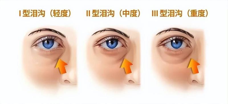 对于爱美的女性同胞们而言，眼周肌肤往往是率先敲响衰老警钟的区域。即便是那些妆容精致、护肤到位的“小仙女”，也常常无奈地面对“眼尾纹”和“泪沟”的困扰。单靠外部的涂抹与修饰，