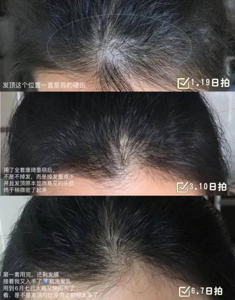 一直以为自己脸大，额头大，来植发医院上班后才知道是自己发际线高。 因为这个小护士本人了性格非常好，非常爱笑，所以我们就化名叫笑笑吧，笑笑在没来雍和植发前，总觉得是自己脸大，额