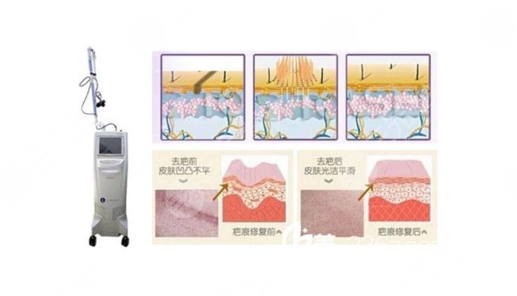 如何祛除脸上的疤痕?