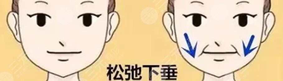 下颌缘提升
