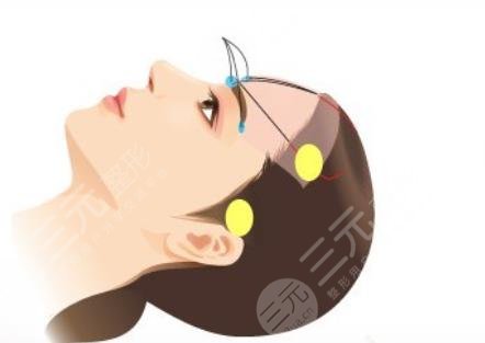 拉皮