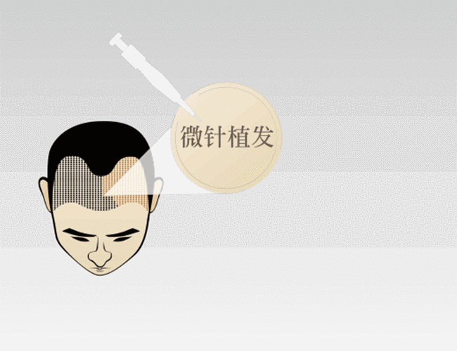 在这个颜值即正义的时代，头发的重要性不言而喻。一头浓密的秀发，不仅能提升个人形象，更是自信心的来源。然而，随着生活节奏的加快和压力的增大，脱发问题日益困扰着许多人。植发技术