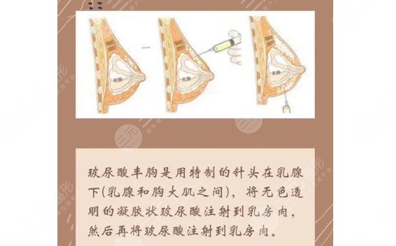 玻尿酸丰胸优缺点