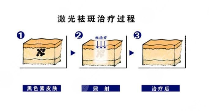 激光祛斑有后遗症吗?