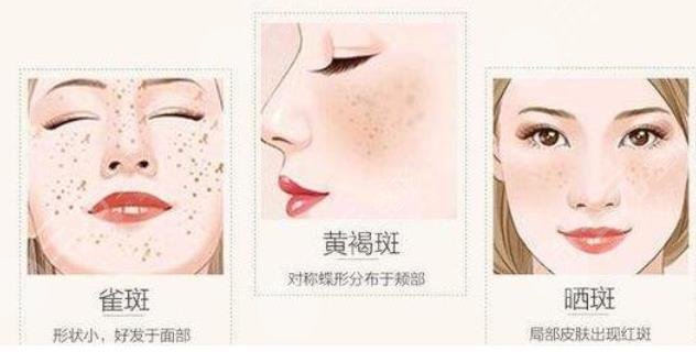 激光祛斑有后遗症吗?