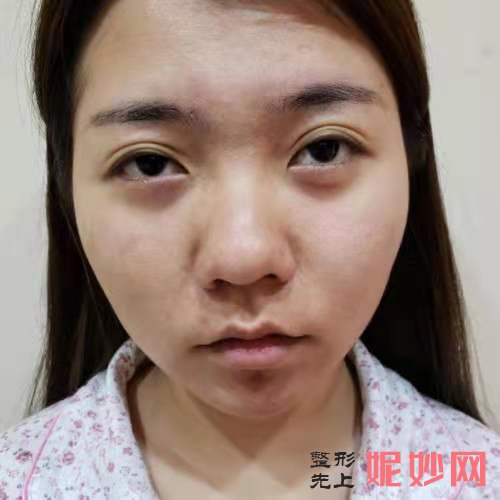 全国有名的双眼皮修复专家谁较厉害？附双眼皮修复案例和价格表