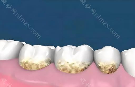 如何清除黑色牙菌斑?汇总几个实用建议