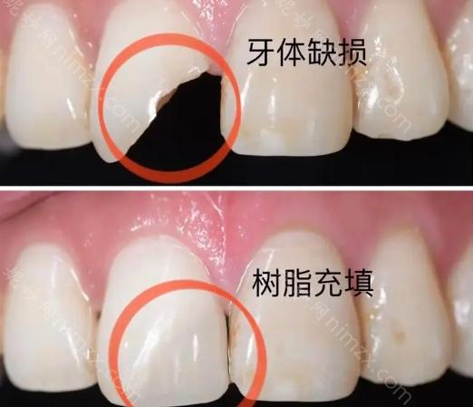 北京正规医院补牙费用一览：3M树脂补牙300元左右，德国VOCO树脂补牙330元起，美国科尔树脂补牙400-1000元之间，瑞士康特树脂补牙价格通常在500-800元起/颗。