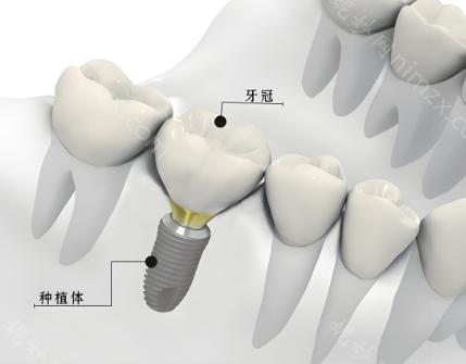 德国Ankylos种植牙属于什么档次?是高端品牌