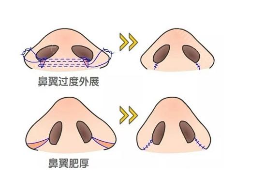 昆明艺星做鼻部整形好不好?金辉医生隆鼻/鼻修复价格以及真人案例分析