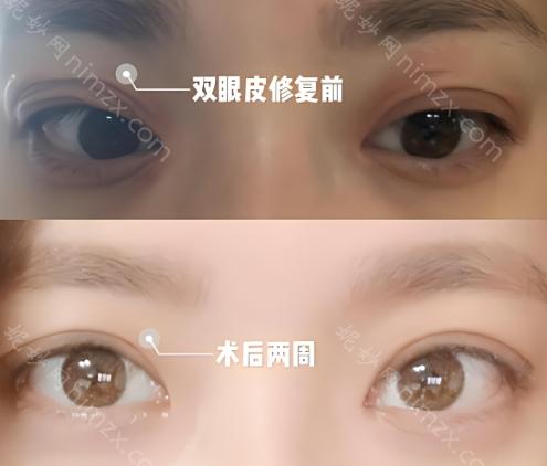 宋蔚医生做双眼皮效果好不好?技术亮点、收费以及专业实力一览