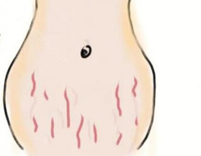 妊娠纹激光手术多少钱?很多女性爱美人士在生完孩子以后会留下来妊娠纹，只不过是严重程度不一样，对于比较轻微的妊娠纹还可以忍受，但是有的妊娠纹比较严重，确实不好看。即使去除妊娠纹