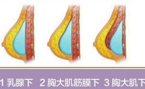 泉州海峡隆胸做的好的医生有吴诗权，许丽琳，林婷婷，王振荣等这几位医生在隆胸手术上都有较强的实力。要说在众多医美整形项目中，比较受欢迎的整形项目隆胸手术可以排在前面，因为好看的胸型，可以为爱美者提升气质和魅力，所以受众群体比较广，隆胸手术热度一直居高不下。本文就对泉州海峡隆胸做的好的医生做相关介绍。有...