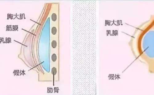 栾杰医生的隆胸技术还是很好的，而且术后的成果，得到了很多爱美人的反馈，隆胸术后不容易感染，形态和手感都是比较自然的，该医生是中国医科院整形美容外科医院门诊的副院长，同时还是胸部整形美容，外科行业优质人才和领军人物。关于栾杰医生的隆胸收费还是很合理。因为隆胸的方式不同，和假体的品牌都是有所差异的，所以...