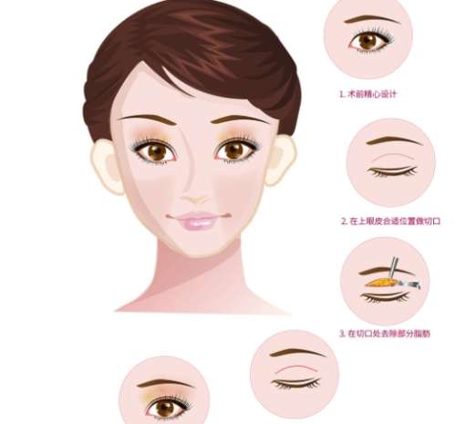 双眼皮