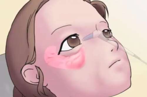 眼袋