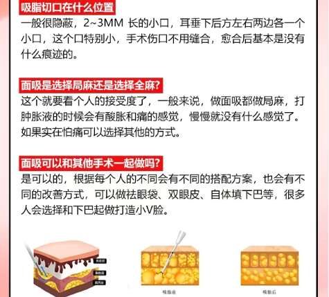 面吸