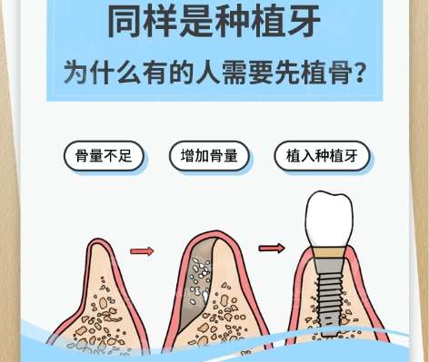 牙齿种植