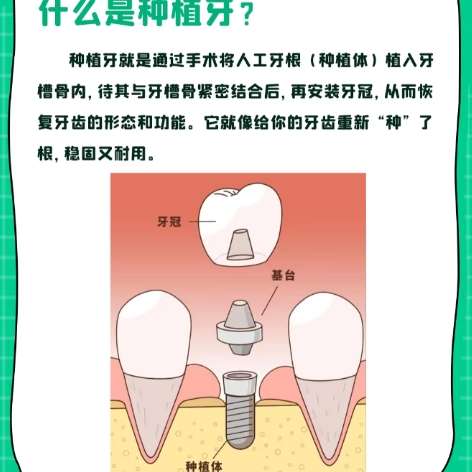 牙齿种植