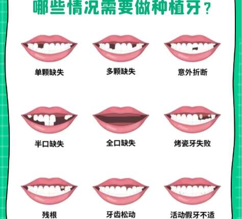 牙齿种植