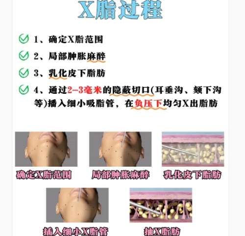 面吸