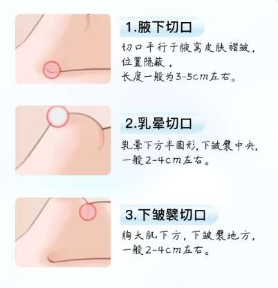 隆胸