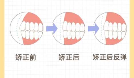 牙齿矫正
