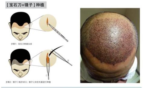 1、南宁贞韩医疗美容医院植发技术概览 南宁贞韩医疗美容医院，作为一家集纯韩整形、韩医保健、无创注射美容、激光美容、无痕植发等五大中心为一体的医疗美容机构，以其精细、严谨、专业