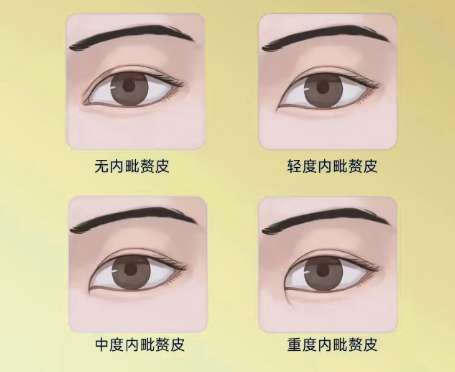 双眼皮