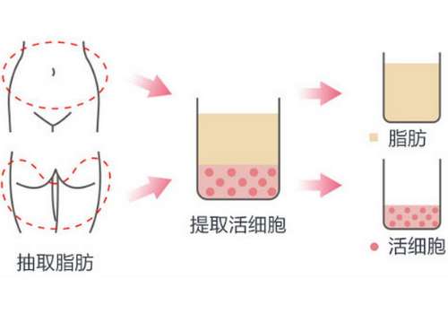 宁波第六医院脂肪填充价格！不要再因为面部凹陷，体型不优美而发愁了，通过美容行业内的脂肪填充技术，可以缓解凹陷，重塑身材。这种形式操作过程简单便捷，术后创伤小恢复快，但是由于项目热门能够操作的医院比较多，所以大家在进行挑选的时候一定要认真做攻略。宁波第六医院整复外科中拥有出色的脂肪填充医生，以杨娴娴医...