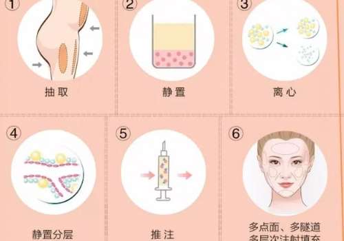 安徽省立医院脂肪填充费用是多少?有不少的人总是想要拥有好的外在形象，脂肪填充就给很多人的美丽带来了希望。哪儿凹陷填哪里，哪里不美，塑形哪里，一下子把岩石可以提升好几个档次。安徽省立医院可是当地响当当的存在，在医疗水平和医生技术上都是比较可靠的。但是大家对于收费问题并不是很清楚。由于价格受到多种因素所...