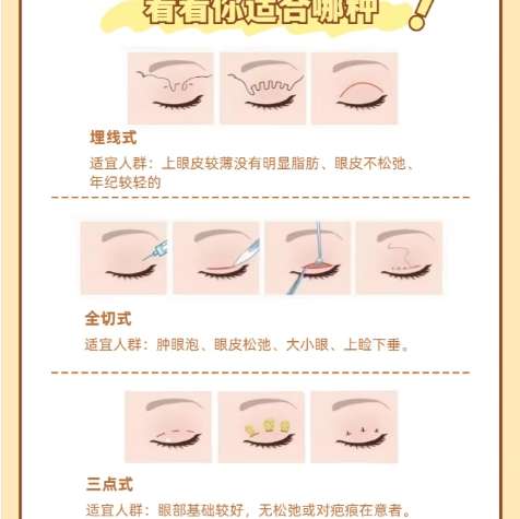 双眼皮