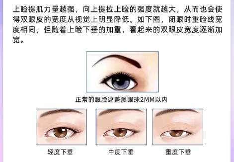 双眼皮