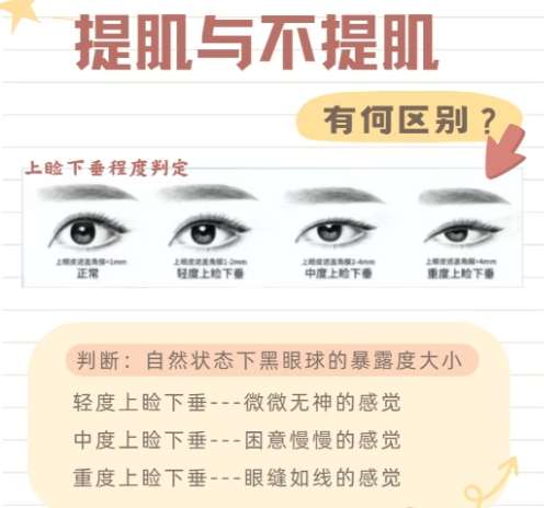 双眼皮