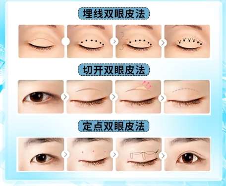 双眼皮