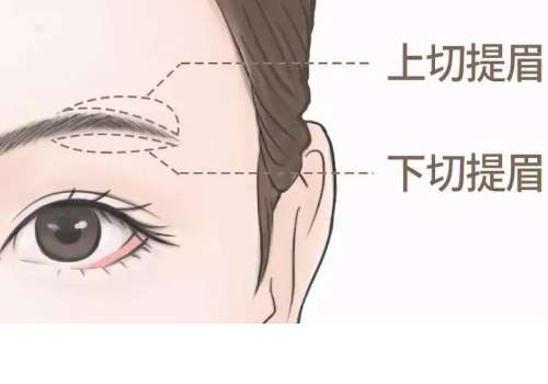 北医三院提眉手术费用多少?1万元起，提眉手术能够解决上睑部位肌肤松弛问题，能够调整眉形，让眉眼线条更加的清晰漂亮，从而提高个人的气质。北京地区的医美资源相当丰富，有很多医院对于提眉手术都很擅长，其中北京大学第三医院的整形医生对于提眉手术应用更加娴熟和规范，可以带来专属手术操作，反馈很好，以下是相关内...