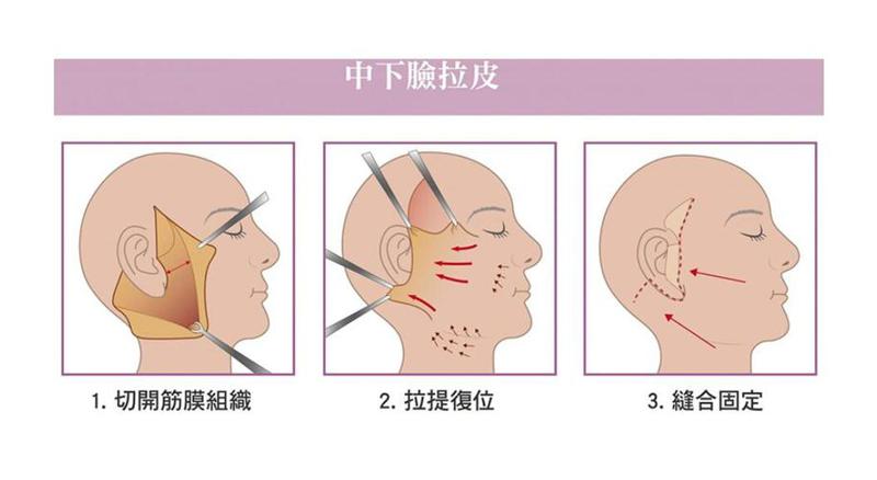 广州拉皮除皱手术价格费用多少？俗话说得好，“爱笑的人运气不会差”，但岁月不饶人，随着时光的流逝，那些曾经灿烂的笑容或许会被皱纹悄悄侵蚀。皱纹，这个让人头疼的问题，总是悄无声