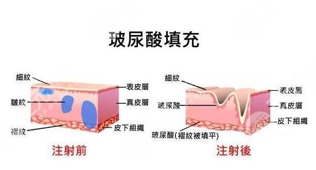 在无锡整形美容行业中，专业医生团队的技术水平直接影响着求美者的术后效果。无锡韩雪医生作为玻尿酸注射领域的专业医师，凭借丰富的临床经验和细致的美学设计，为众多求美者实现了自然
