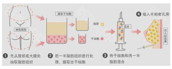 自体脂肪隆鼻作为一种非手术的隆鼻方式，近年来备受求美者青睐。尽管无需开刀，但其对医生的技术要求极高。选择一位经验丰富的医生至关重要。今天，我们将为大家推荐北京地区十位在自体